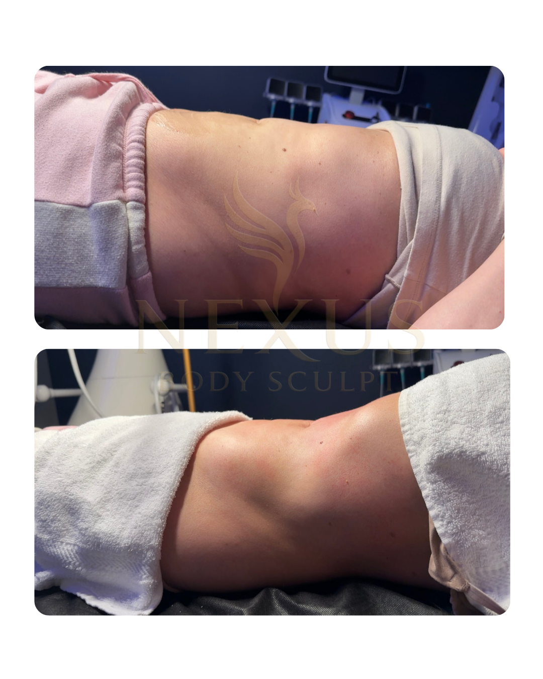 Comparison of a person's side before and after body sculpting treatment, showing reduced fat and a more contoured appearance.