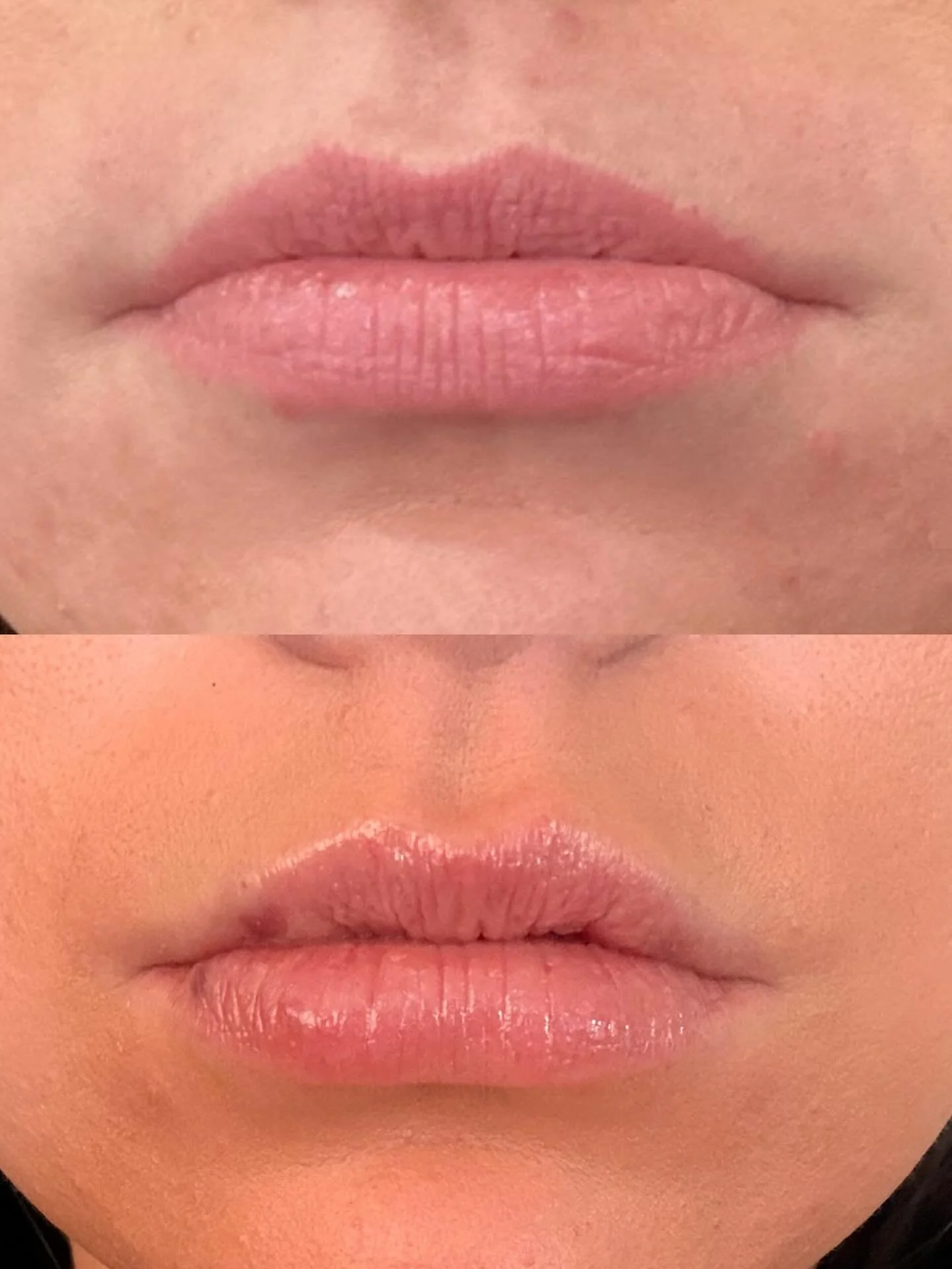 Nervous about ducky lips? You&rsquo;re not alone 💕🫶

At Pearl City Medspa, we inject within your natural borders and avoid over-projection&mdash;that&rsquo;s why even &frac12; syringe of Kysse looks soft, balanced, and natural 💋✨

Curious what a s