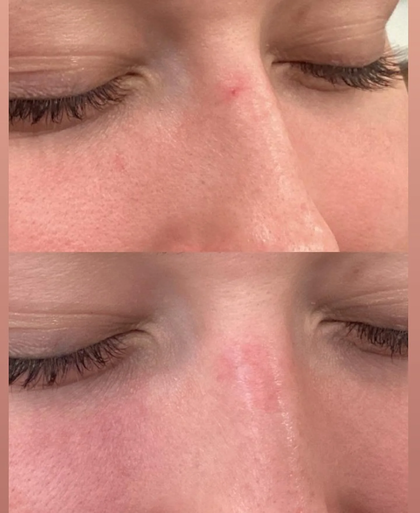 🗣️&ldquo;I&rsquo;m sick of hiding this with concealer.&rdquo;

Say less.

Our long-pulse YAG laser erased this pesky capillary on the nose in a single treatment ✨

There is less than 5 minutes between the two photos 🤯