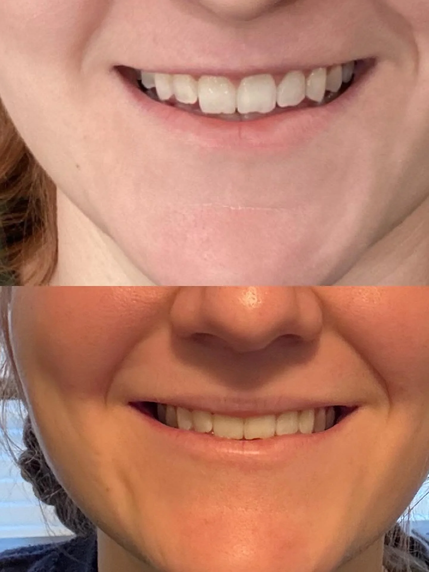 Look at how a subtle lip flip helps add the appearance of a bigger upper lip! ✨Without✨added filler 😏

Lip Flip vs. Lip Filler &mdash; What&rsquo;s the difference?💋💋💋

A lip flip uses a small amount of neuromodulator (Botox/Dysport) to gently rel