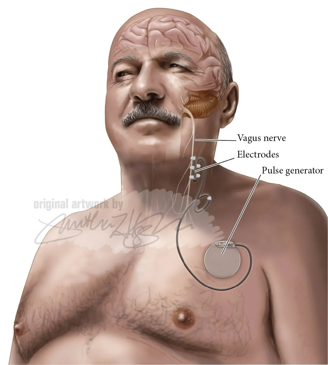 Adobe Photoshop with Illustrator, figure for psychopathology text showing vagus nerve pulse generator device. 