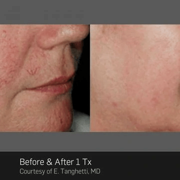 Thread-Vein-Treatment 2.png