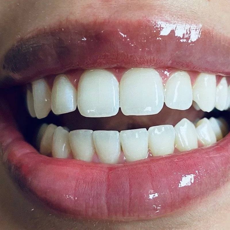 Teeth Whitening Fort Worth.jpg