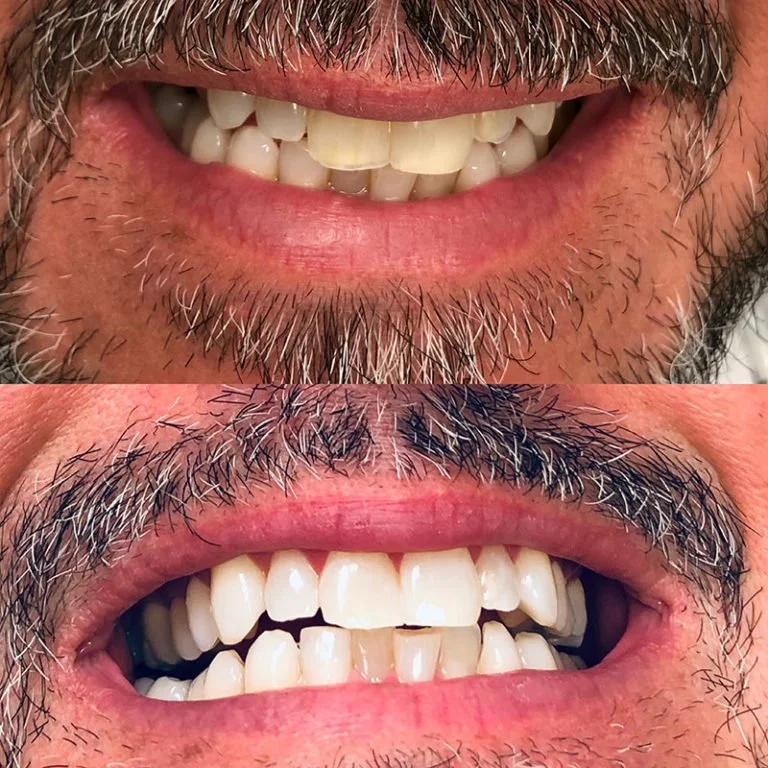 Teeth Whitening Before After (8).jpg
