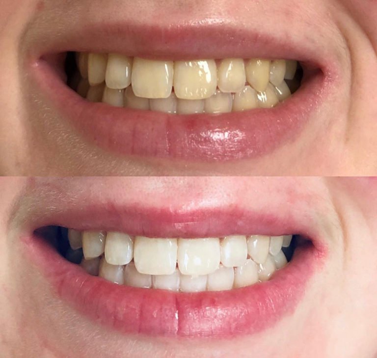 Teeth Whitening Before After (1).jpg