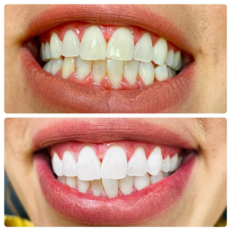 Teeth Whitening Before After (7).jpg
