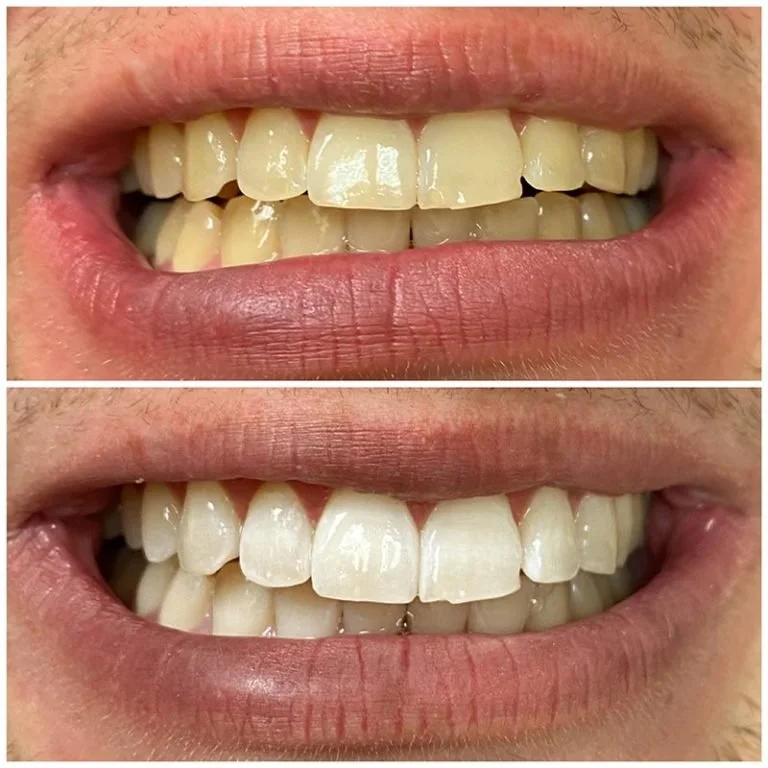 Teeth Whitening Fort Worth (13).jpg