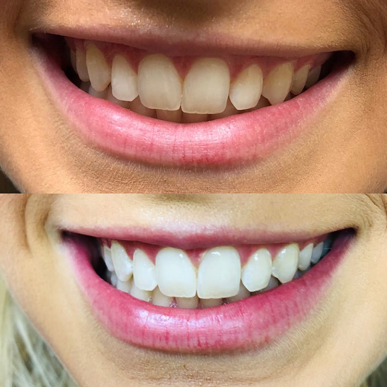 Teeth Whitening Before After (5).jpg