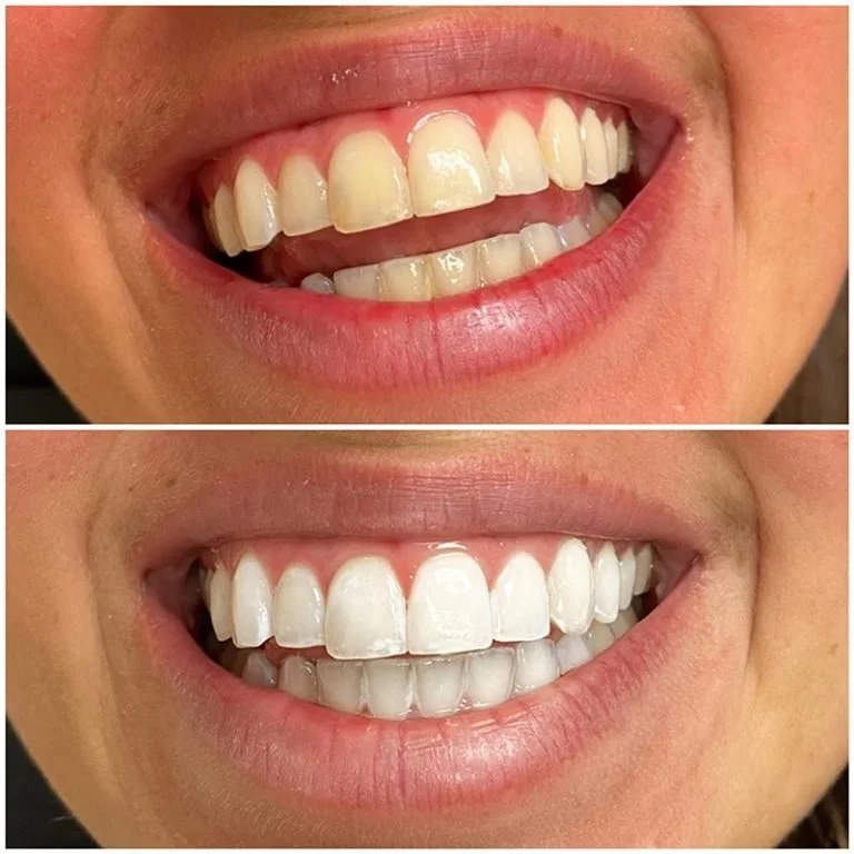 Teeth Whitening Fort Worth (8).jpg