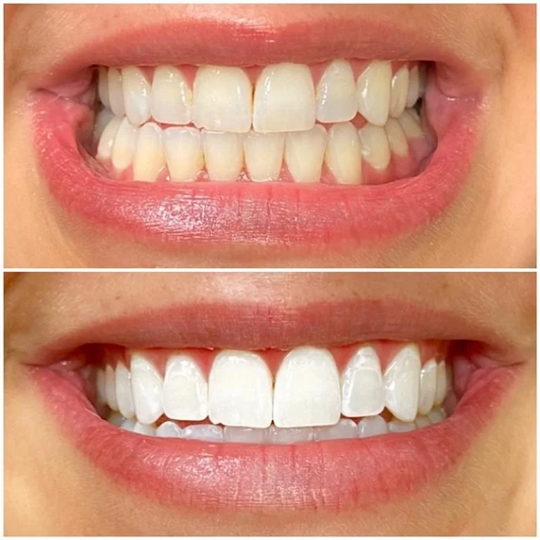 Teeth Whitening Fort Worth (12).jpg