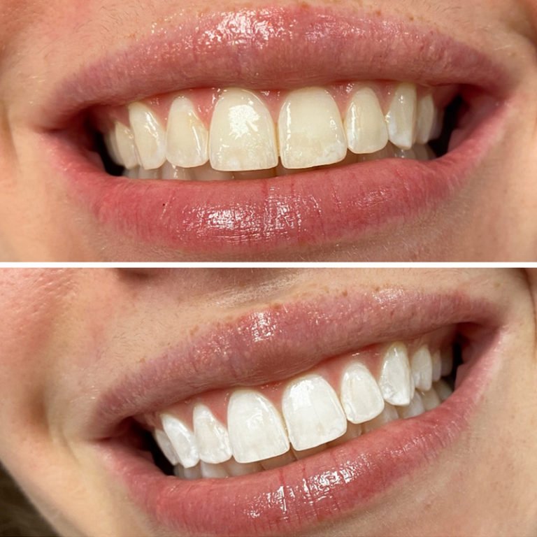 Teeth Whitening Fort Worth (5).jpg