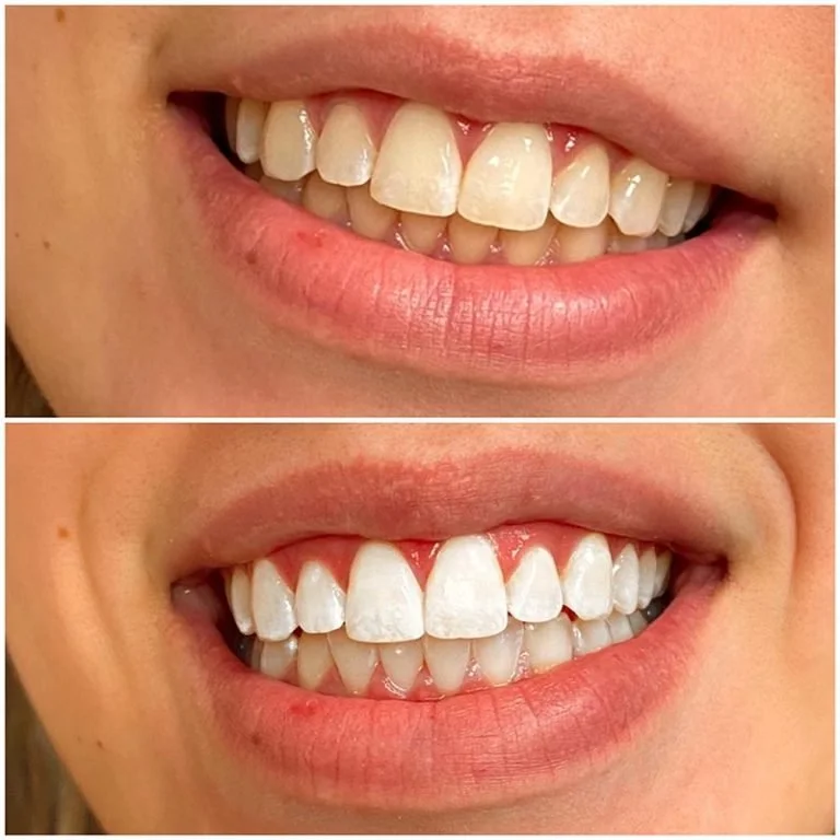 Teeth Whitening Fort Worth (10).jpg