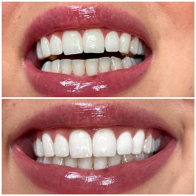 Teeth Whitening Fort Worth (1).jpg