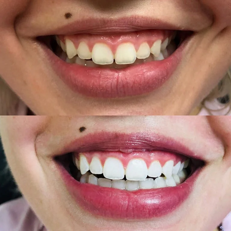 Teeth Whitening Before After (4).jpg