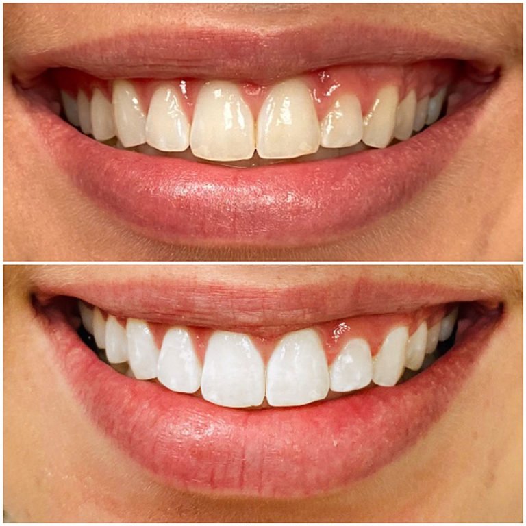 Teeth Whitening Fort Worth (3).jpg