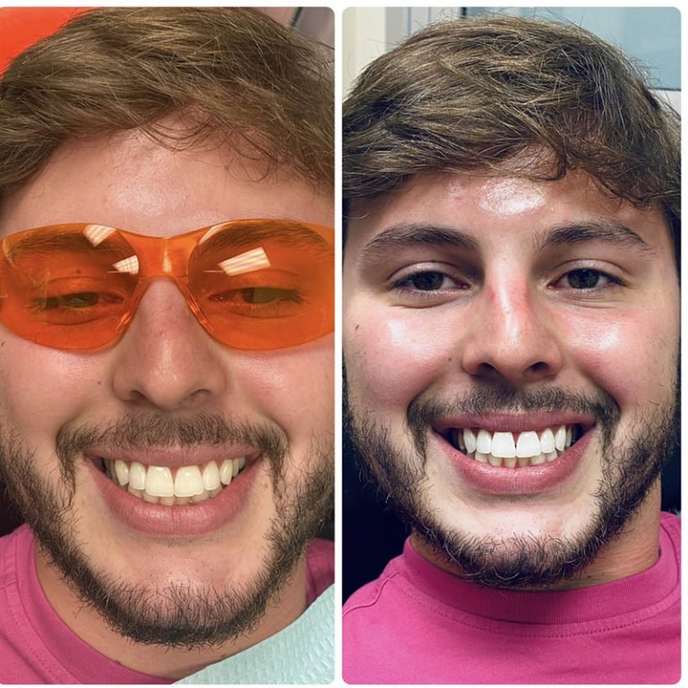 Teeth Whitening Before After.jpg