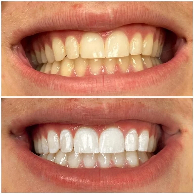 Teeth Whitening Fort Worth (9).jpg