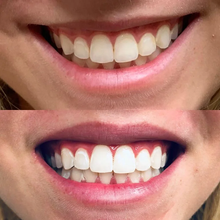 Teeth Whitening Before After (2).jpg