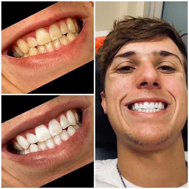 Teeth Whitening Fort Worth (11).jpg