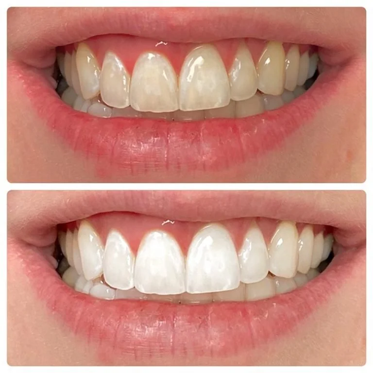 Teeth Whitening Fort Worth (7).jpg