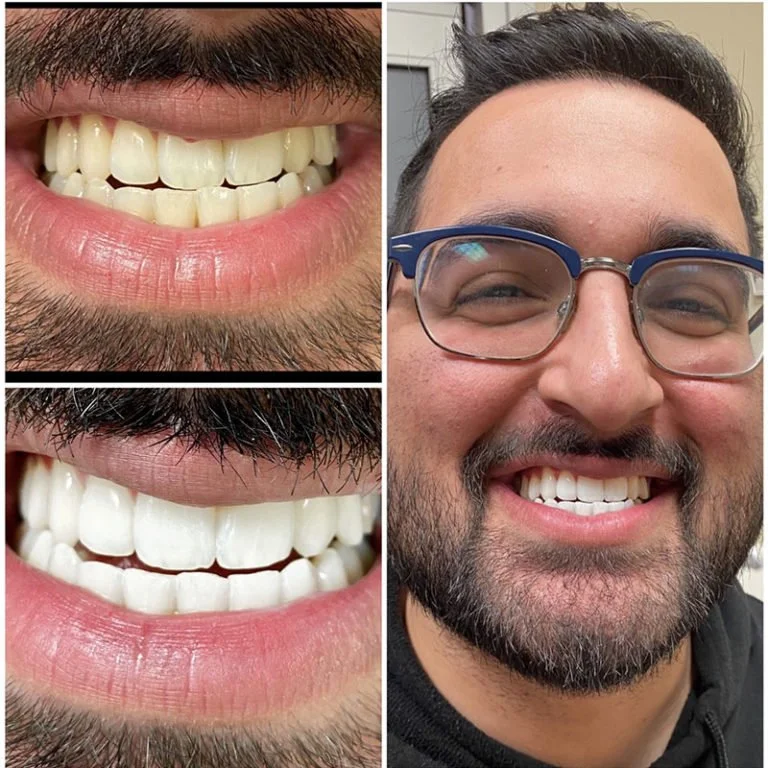 Teeth Whitening Before After (9).jpg