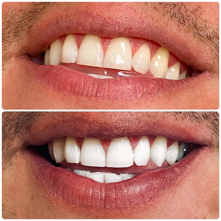 Teeth Whitening Before After (6).jpg