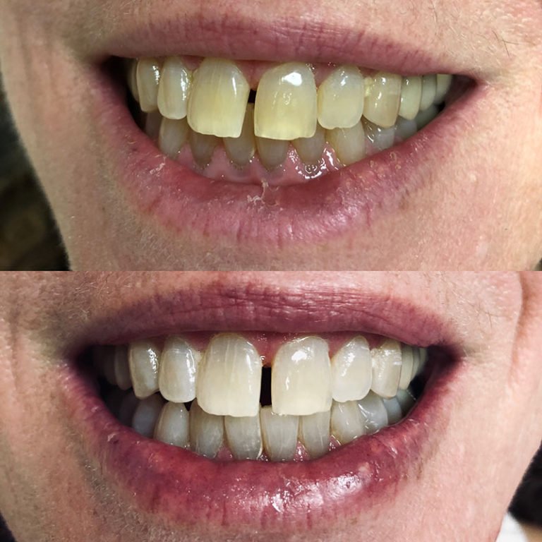 Teeth Whitening Before After (11).jpg