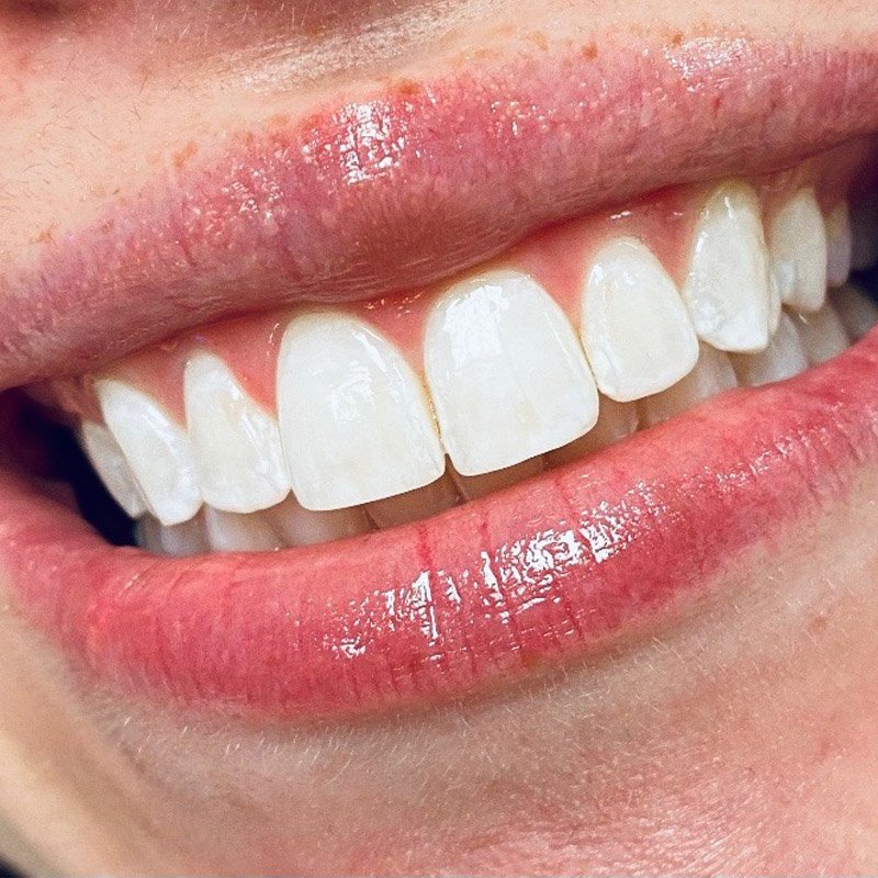 Teeth Whitening Fort Worth (2).jpg