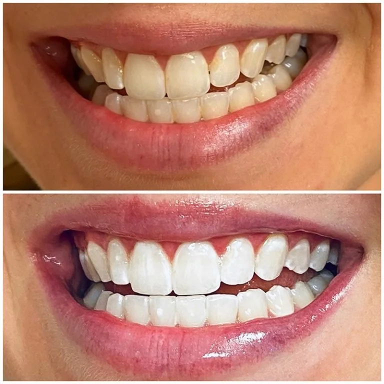 Teeth Whitening Fort Worth (14).jpg