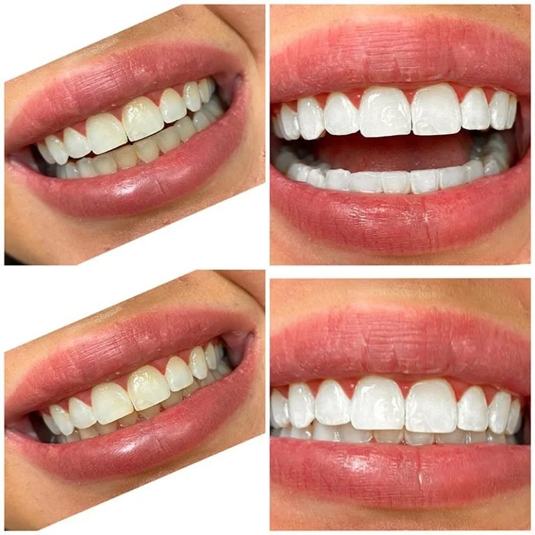 Teeth Whitening Fort Worth (6).jpg