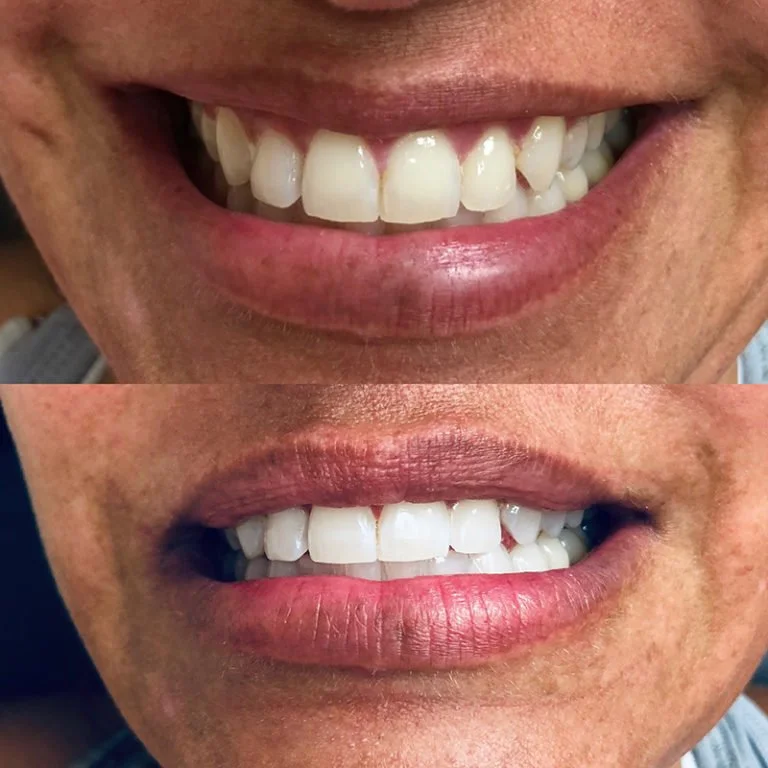 Teeth Whitening Before After (10).jpg