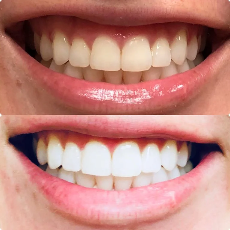 Teeth Whitening Before After (3).jpg