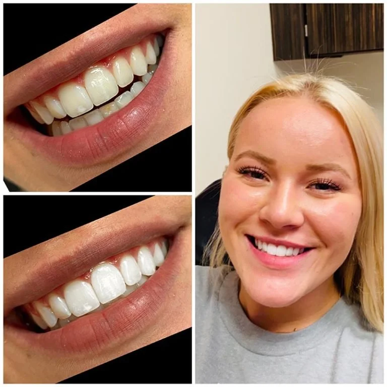 Teeth Whitening Fort Worth (4).jpg