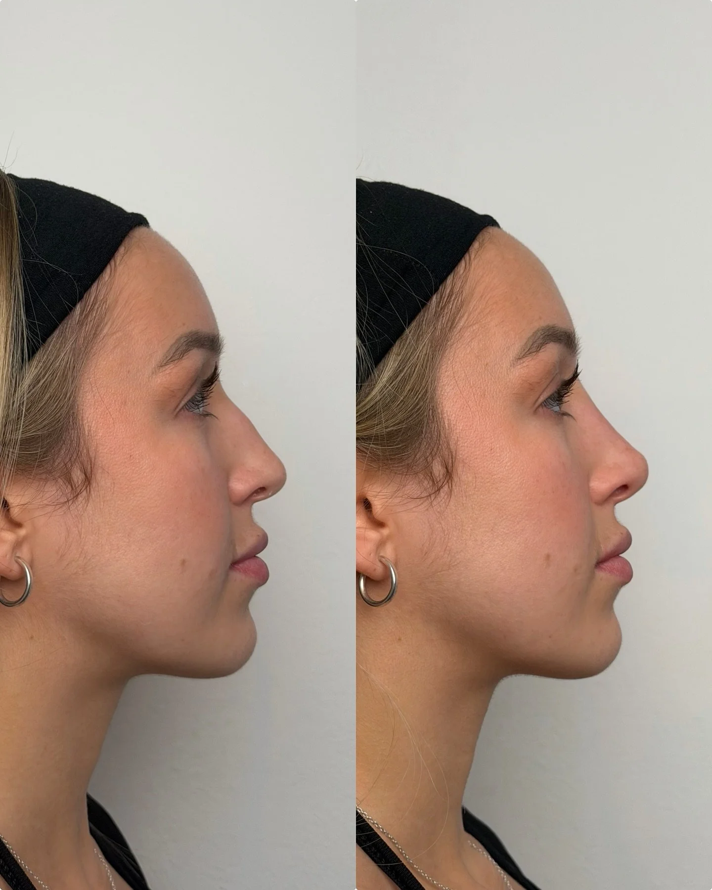 Non surgical rhinoplasty 

Non-surgical rhinoplasty performed to smooth the nasal bridge and create a subtle lift at the tip.

&mdash;&gt; swipe for video results &mdash;&gt;

#nose #nosefiller #nosefillers #rhinoplasty #nonsurgicalrhinoplasty #nosej