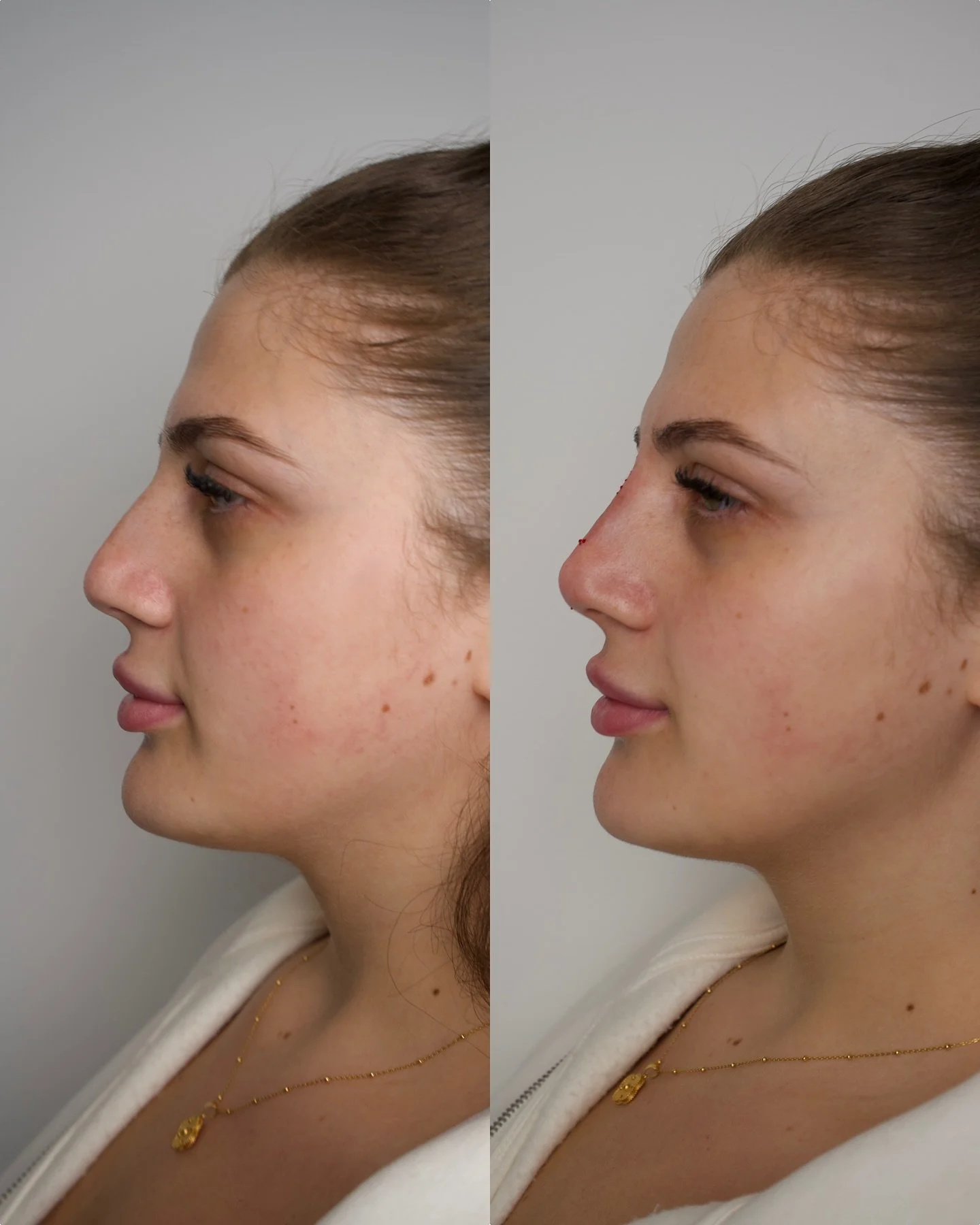 Straight off the needle 🩸

Non-surgical rhinoplasty - enhancing her natural beauty while keeping her features truly hers. Subtle, balanced, and refined.

@casaraclinic 

#nose #nosefiller #nosefillers #nosejob #nonsurgicalrhinoplasty