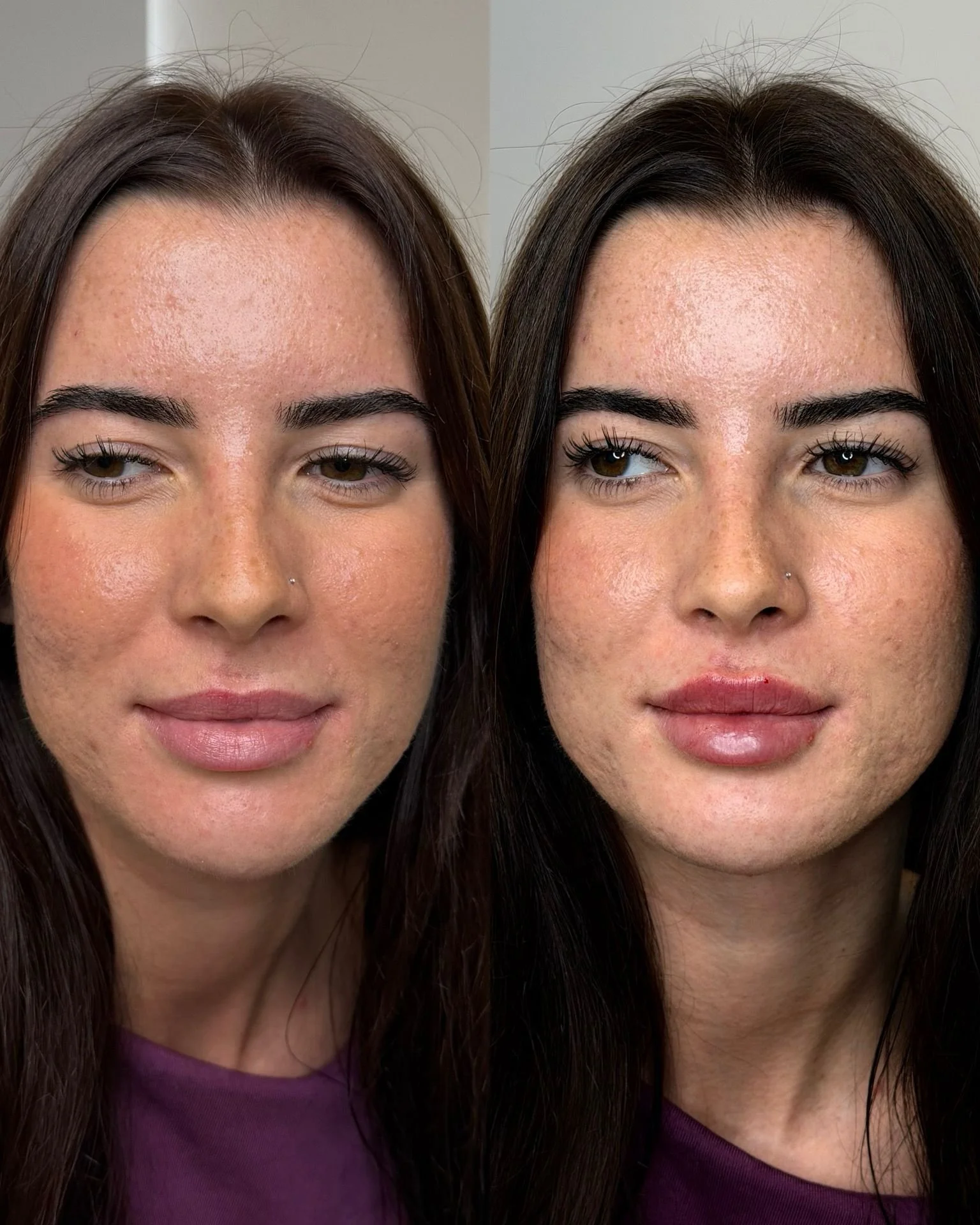 filler_before_after.JPG