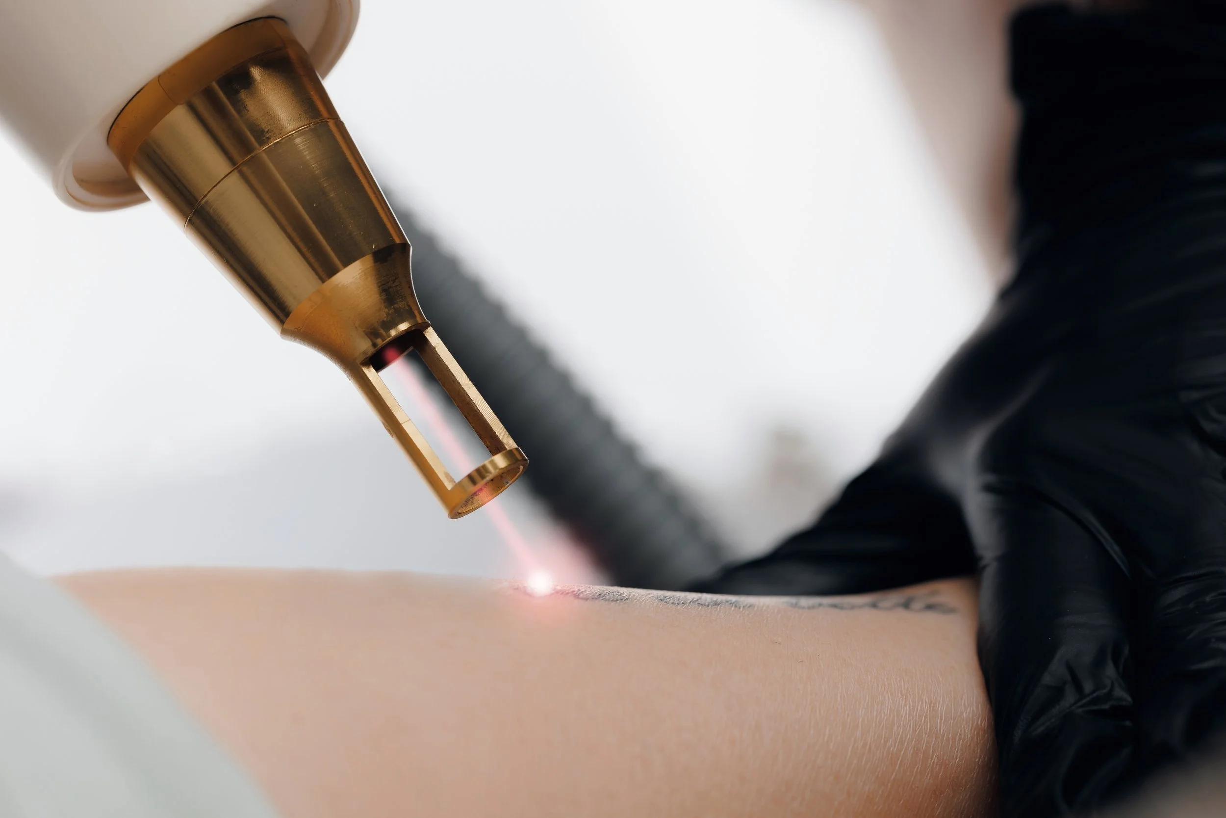 Close-up of a tattoo removal procedure using laser with a technician wearing black gloves.