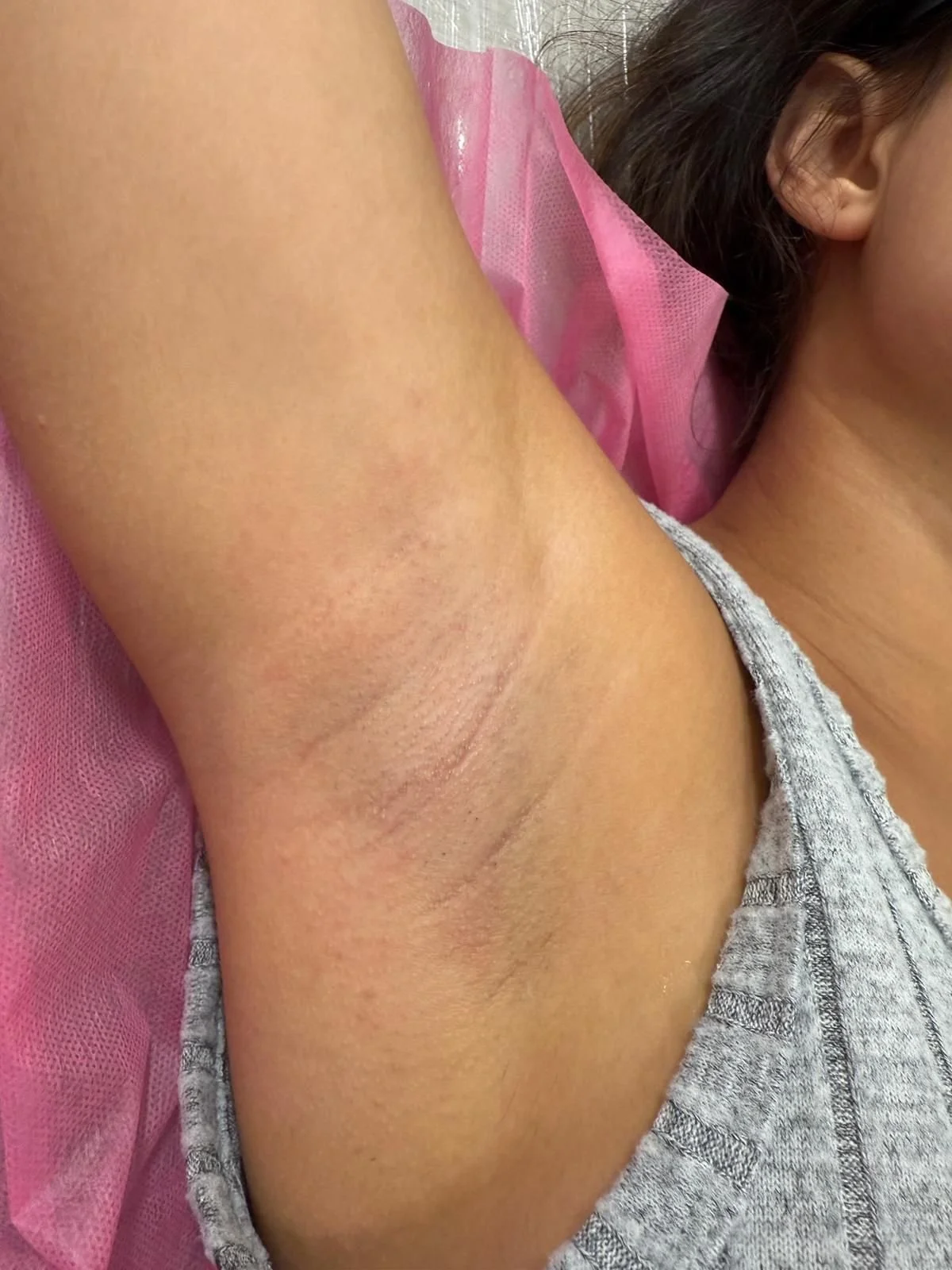 Benefits of Laser Hair Removal