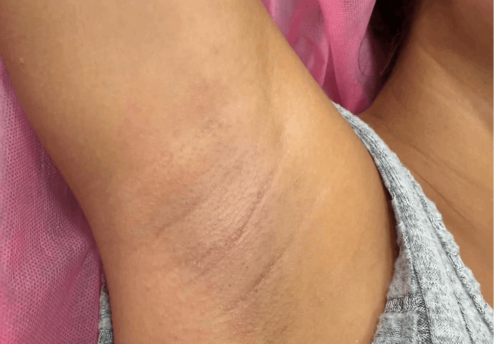 Laser Hair Removal image