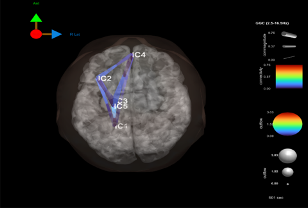 Medical imaging scan showing a cross-section of a brain with labeled regions IC2, IC3, and IC4, along with measurement lines and color-coded intensity scales.