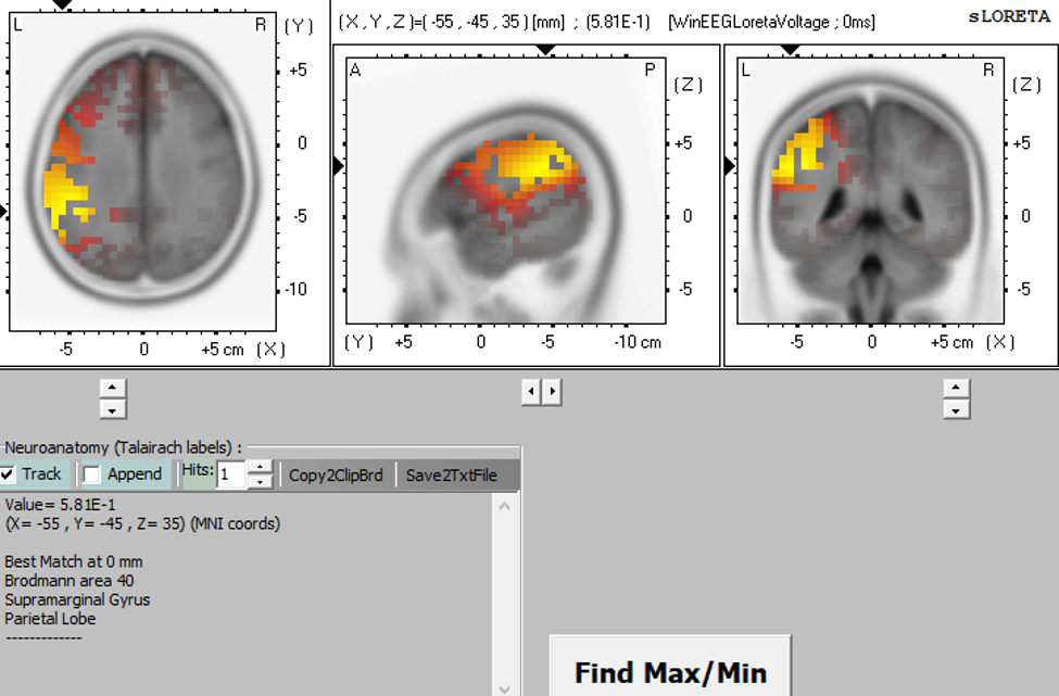 Three brain scans showing activated regions in the brain, with highlighted areas in yellow, orange, and red indicating activity.