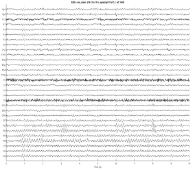 An electrocardiogram (ECG) showing multiple heartbeat waveforms on a grid.