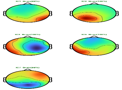 32 channel qEEG brain mapping
