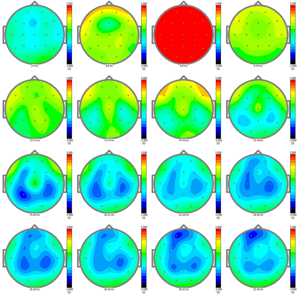 relative power EEG qEEG