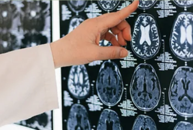 A medical professional's hand pointing at brain MRI scans displayed on a lightbox.