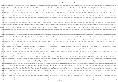 Electrocardiogram (ECG) printout showing multiple waveform traces on a grid background.