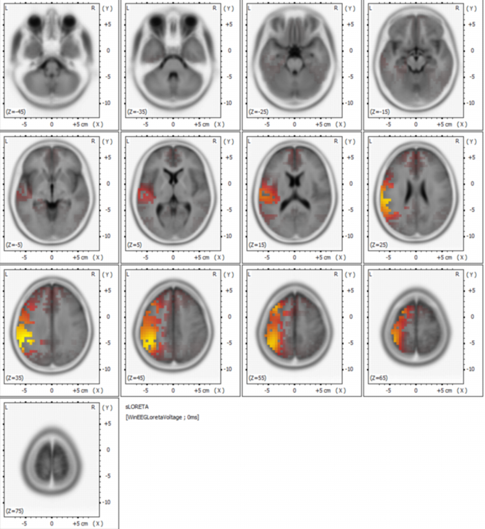 Series of brain scan images showing different slice levels, with some highlighted areas in red, yellow, and orange indicating brain activity or regions of interest.