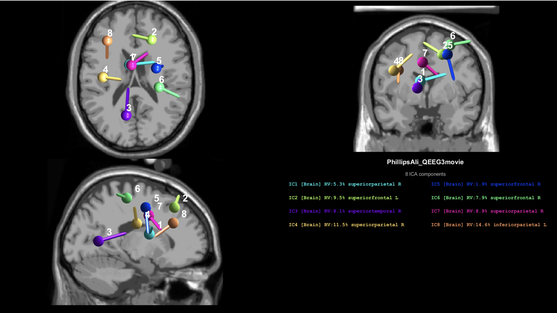 MRI brain scan with colored markers indicating different brain regions and their respective relative volume percentages, labeled with component codes.