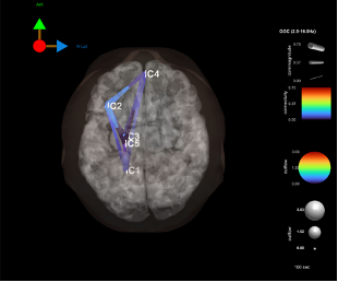 Medical image of a brain with labeled regions and a color scale on the side.