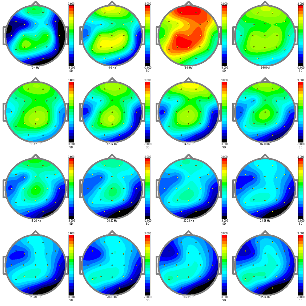 absolute power EEG qEEG